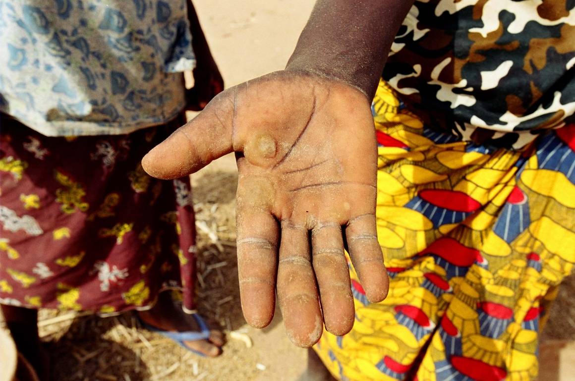 Hånden til en ung kvinne med vannblemmer etter hun har knust hirse i landsbyen Iskita i Niger. Foto: cn1433/ILO/M. Crozet.